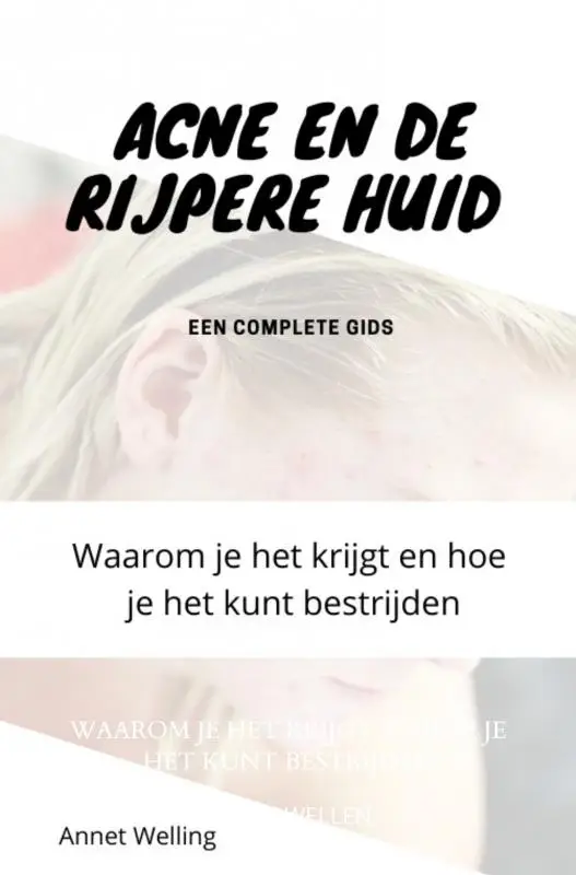 Acne bij volwassenen